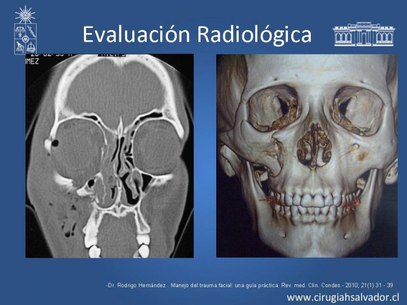 Diapositiva 11 de Trauma Facial: Manejo Quirúrgico de Partes Blandas  