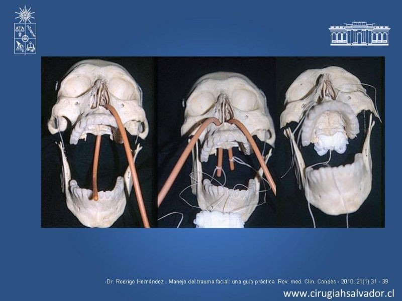 Diapositiva 8 de Trauma Facial: Manejo Quirúrgico de Partes Blandas  