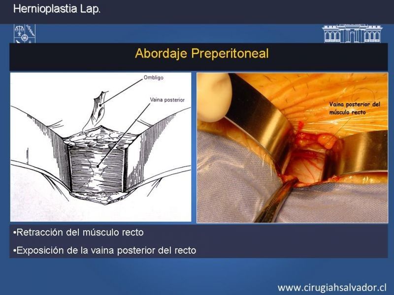 Diapositiva 12 de Hernioplastia Inguinal Laparoscópica