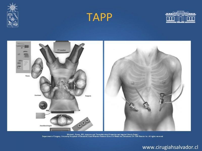 Diapositiva 18 de Hernioplastia Inguinal Laparoscópica