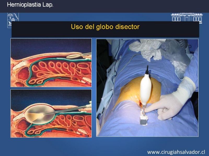 Diapositiva 14 de Hernioplastia Inguinal Laparoscópica