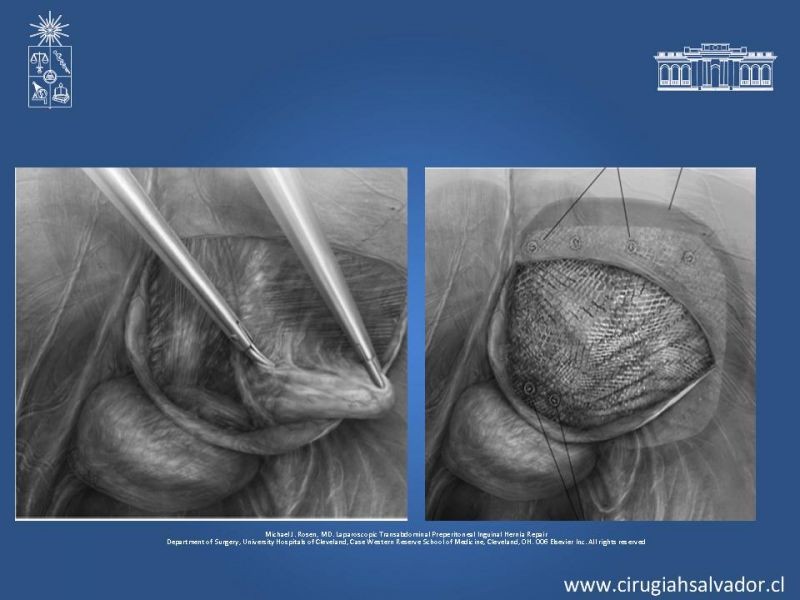 Diapositiva 20 de Hernioplastia Inguinal Laparoscópica