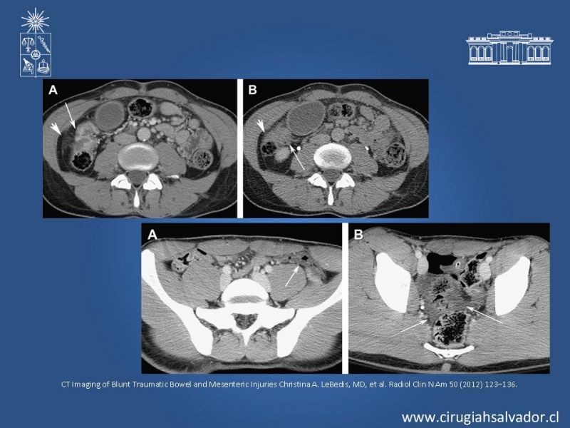 Diapositiva 17 de Imágenes en Trauma Abdominal 