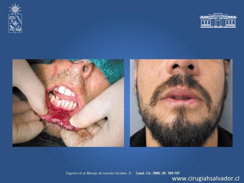 Diapositiva 45 de Trauma Facial: Manejo Quirúrgico de Partes Blandas  