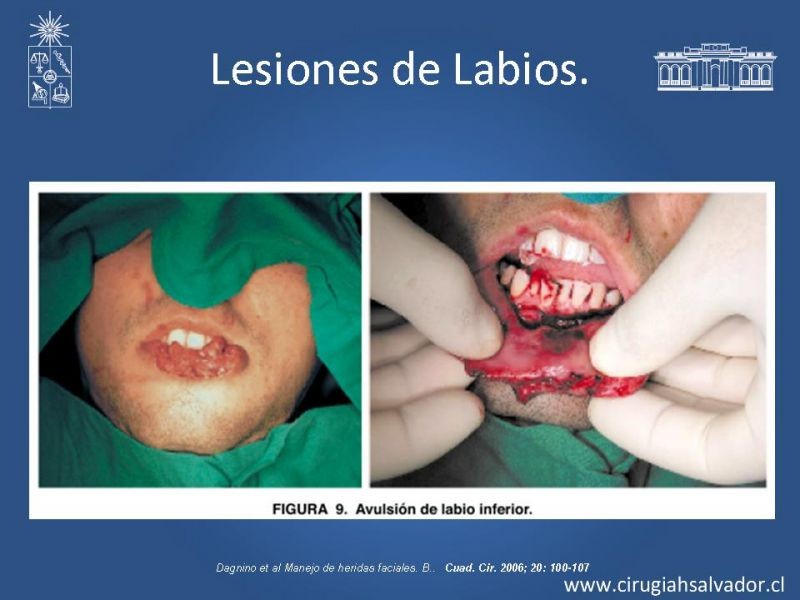Diapositiva 44 de Trauma Facial: Manejo Quirúrgico de Partes Blandas  