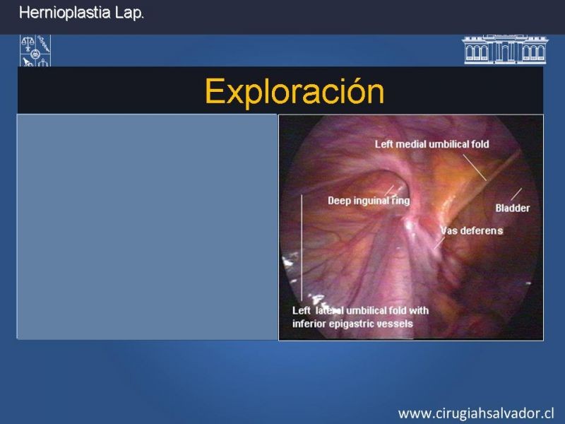 Diapositiva 15 de Hernioplastia Inguinal Laparoscópica