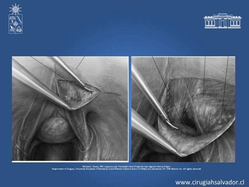 Diapositiva 19 de Hernioplastia Inguinal Laparoscópica