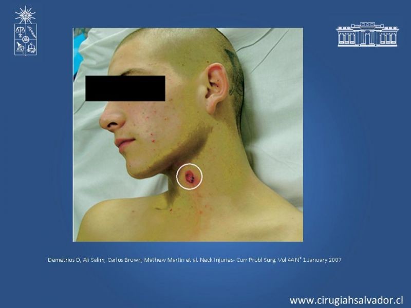 Diapositiva 8 de Manejo del trauma cervical penetrante