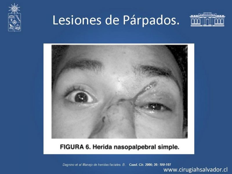 Diapositiva 33 de Trauma Facial: Manejo Quirúrgico de Partes Blandas  