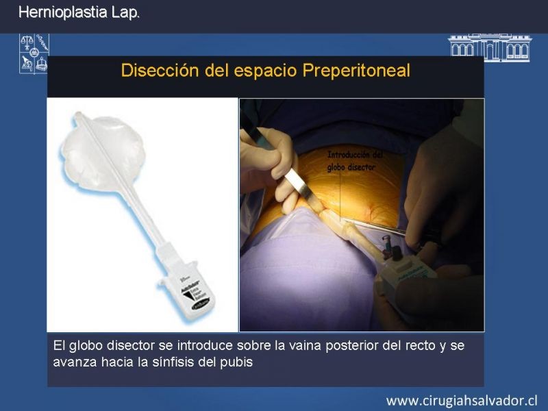 Diapositiva 13 de Hernioplastia Inguinal Laparoscópica