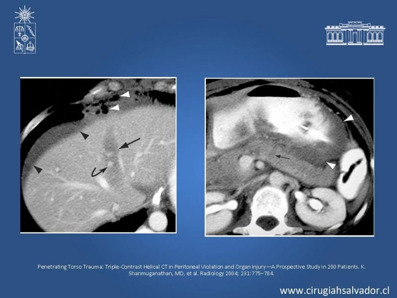 Diapositiva 11 de Imágenes en Trauma Abdominal 