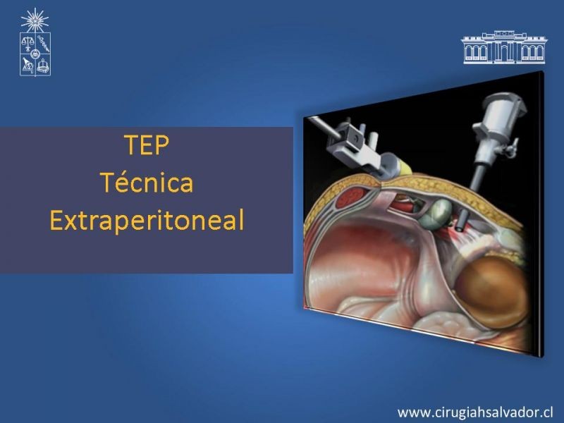 Diapositiva 7 de Hernioplastia Inguinal Laparoscópica