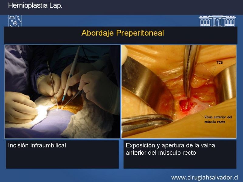 Diapositiva 11 de Hernioplastia Inguinal Laparoscópica