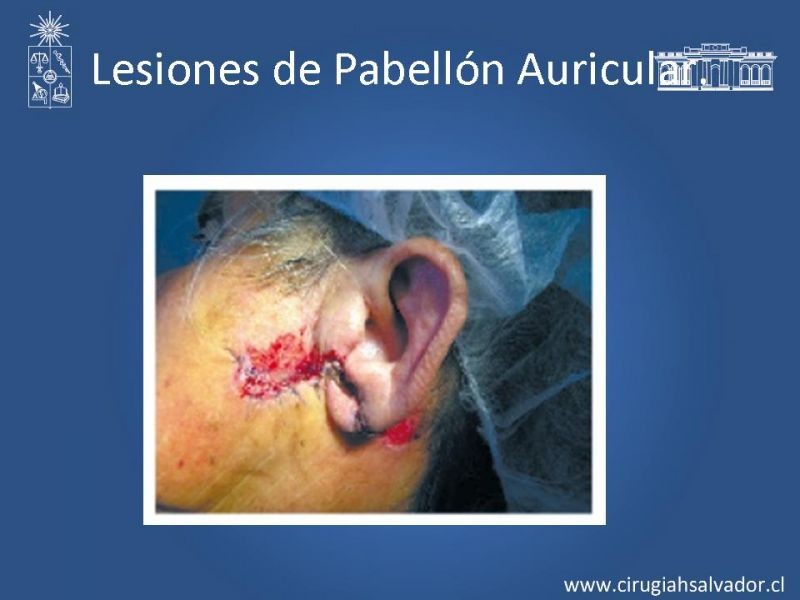 Diapositiva 38 de Trauma Facial: Manejo Quirúrgico de Partes Blandas  