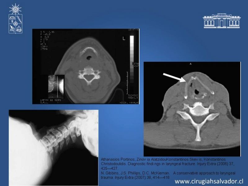 Diapositiva 10 de Manejo del trauma laríngeo