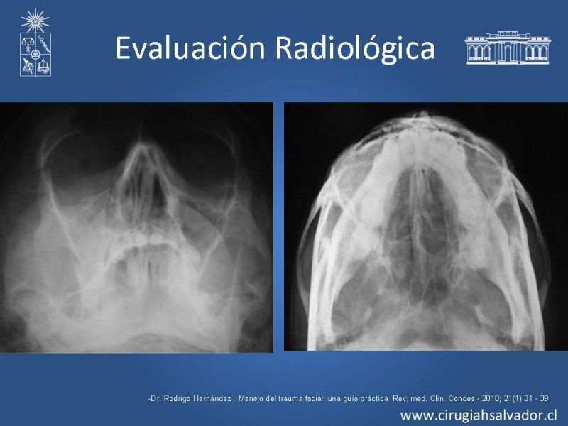 Diapositiva 13 de Trauma Facial: Manejo Quirúrgico de Partes Blandas  