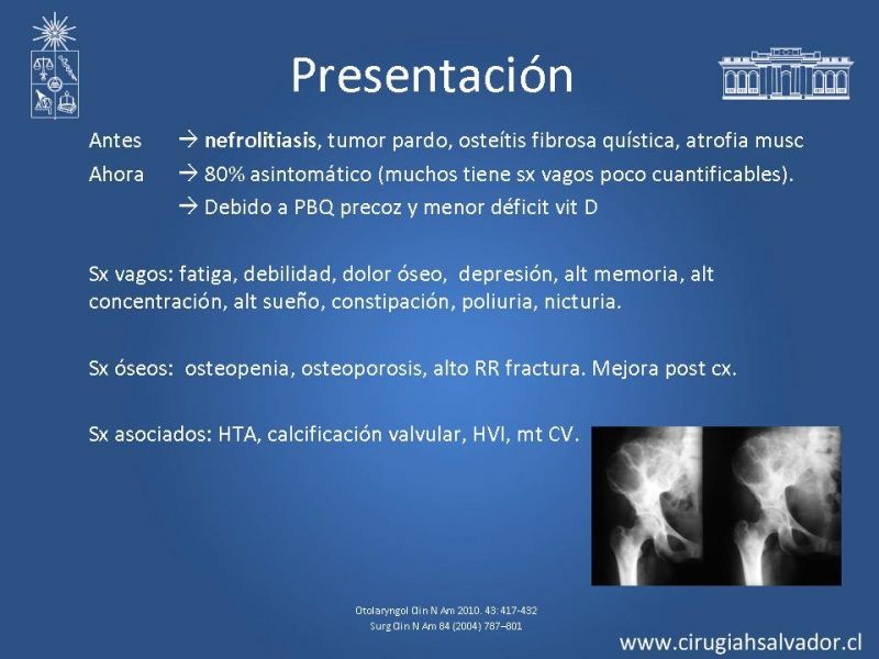 Diapositiva 8 de Hiperparatiroidismo primario