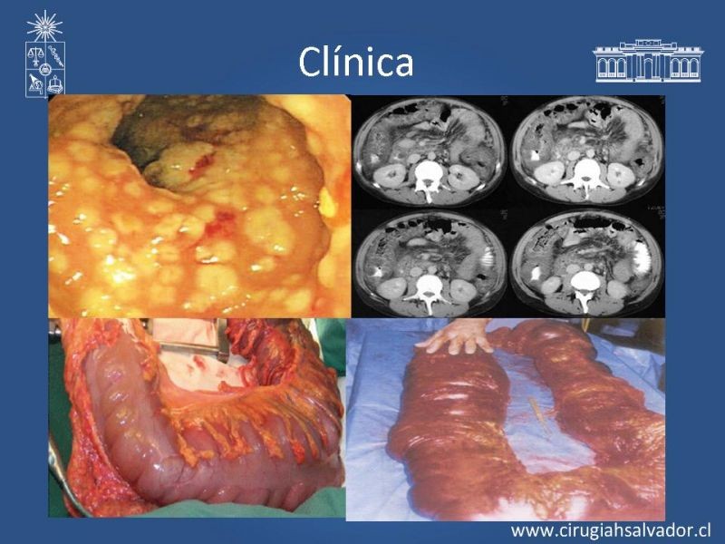 Diapositiva 15 de Diarrea por C. Difficile