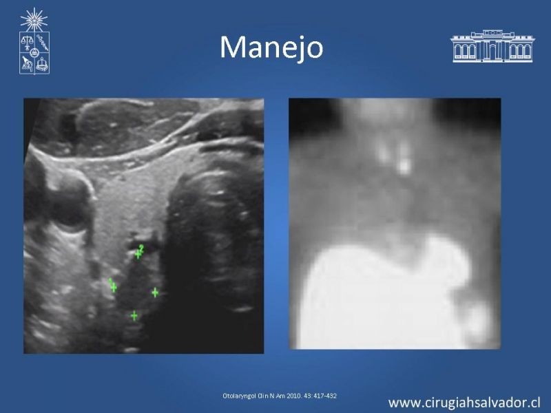 Diapositiva 13 de Hiperparatiroidismo primario