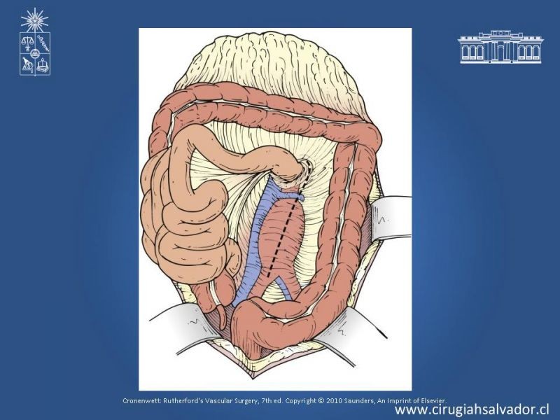 Diapositiva 50 de Aneurisma Aórtico Abdominal Roto