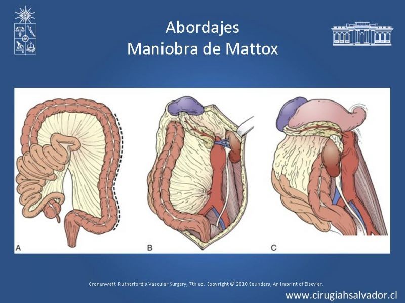 Diapositiva 48 de Aneurisma Aórtico Abdominal Roto