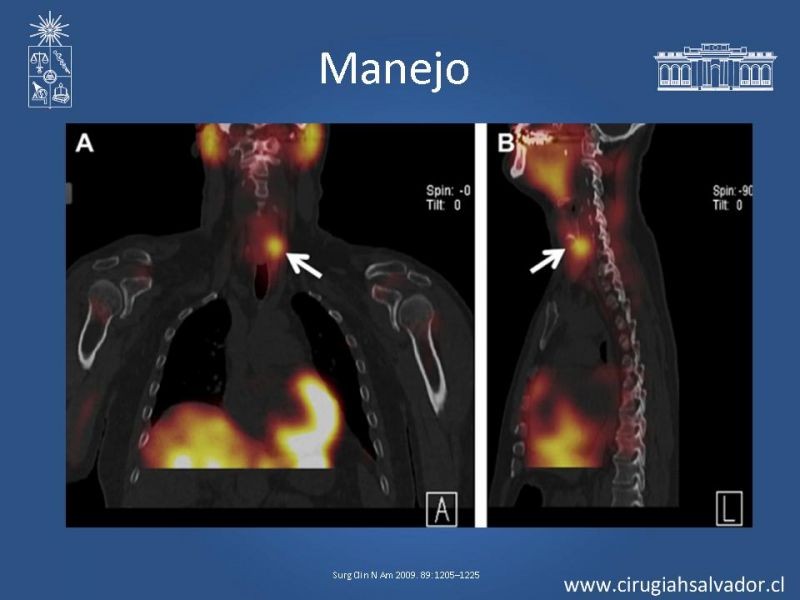 Diapositiva 14 de Hiperparatiroidismo primario