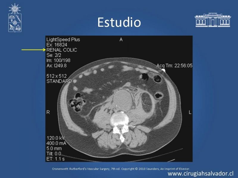 Diapositiva 15 de Aneurisma Aórtico Abdominal Roto