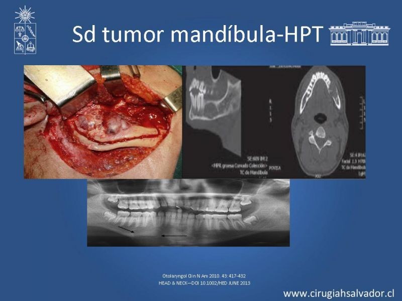 Diapositiva 6 de Hiperparatiroidismo primario