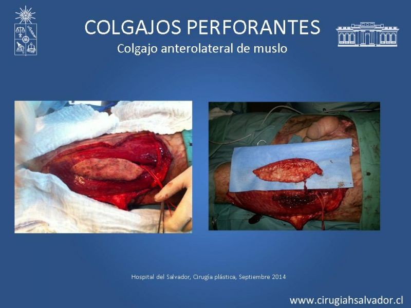 Diapositiva 24 de Colgajos perforantes: Anatomía-usos