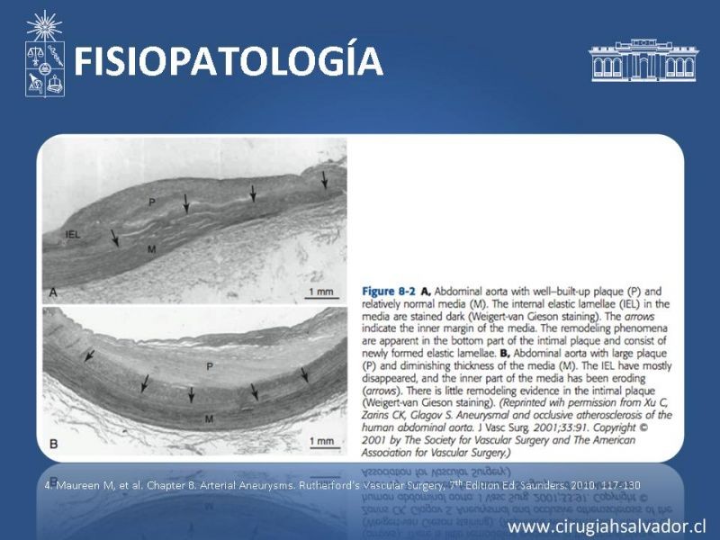 Diapositiva 6 de Aneurismas periféricos