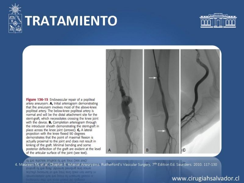 Diapositiva 16 de Aneurismas periféricos