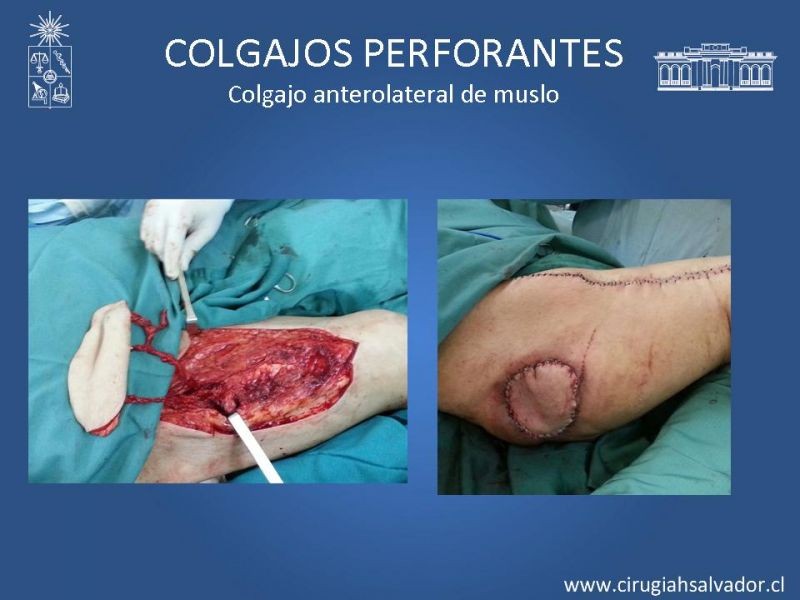 Diapositiva 27 de Colgajos perforantes: Anatomía-usos