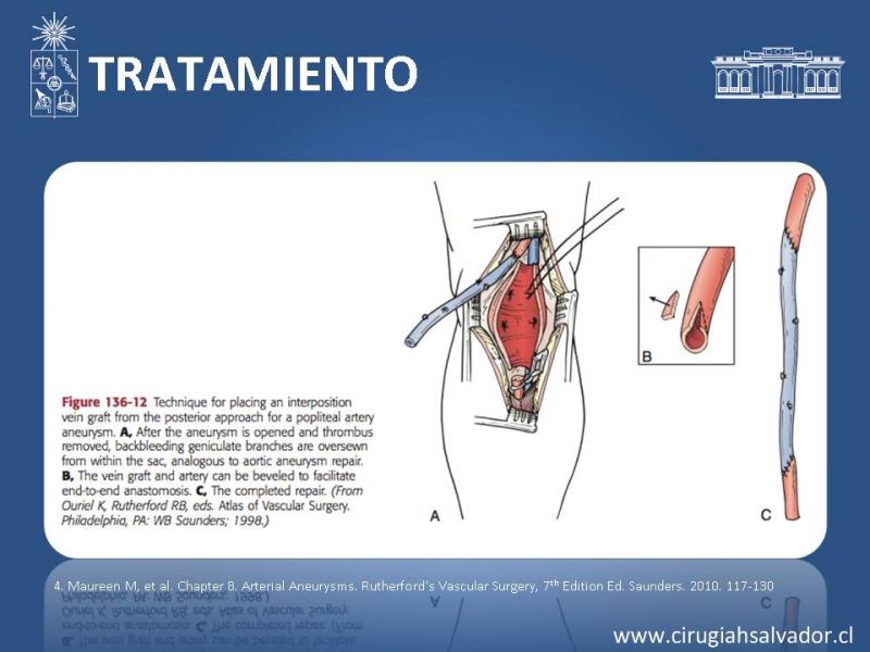 Diapositiva 15 de Aneurismas periféricos