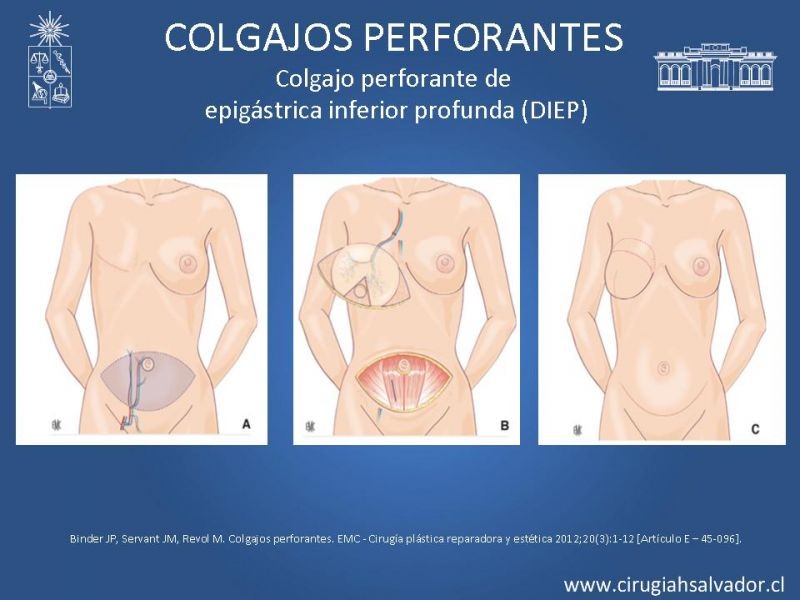 Diapositiva 17 de Colgajos perforantes: Anatomía-usos