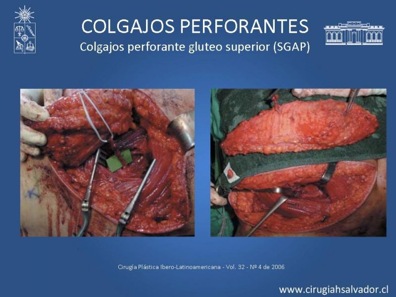 Diapositiva 34 de Colgajos perforantes: Anatomía-usos