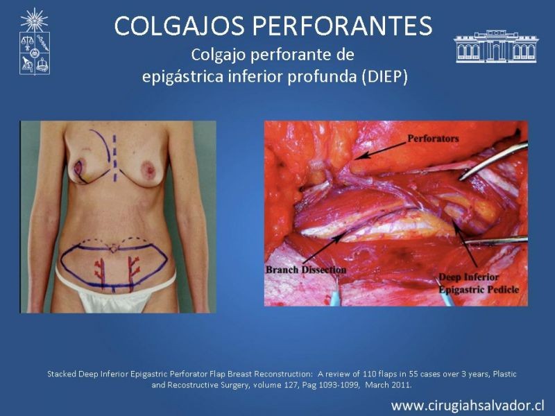 Diapositiva 18 de Colgajos perforantes: Anatomía-usos
