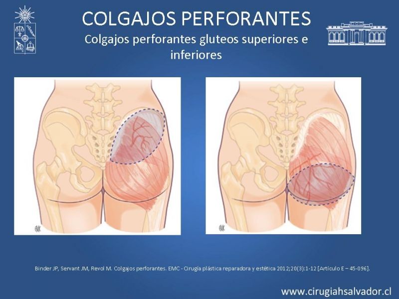 Diapositiva 32 de Colgajos perforantes: Anatomía-usos