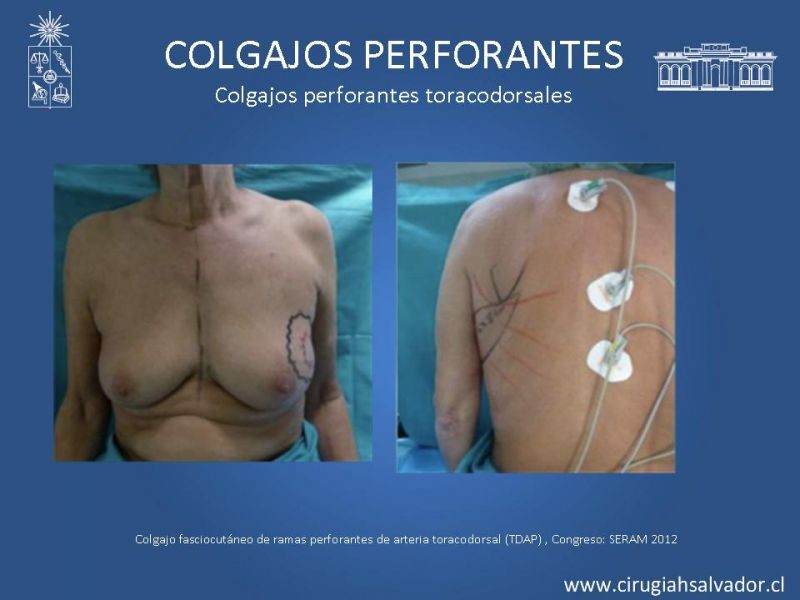 Diapositiva 38 de Colgajos perforantes: Anatomía-usos