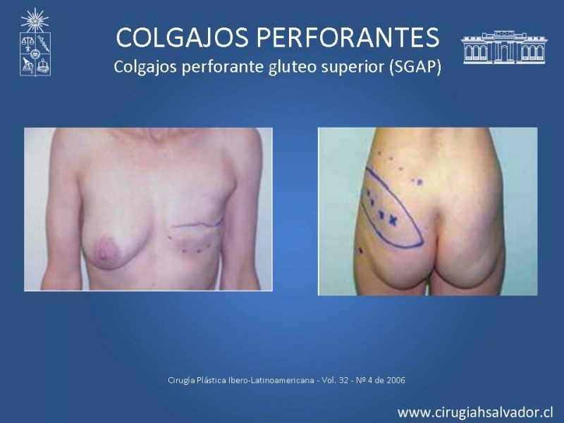 Diapositiva 33 de Colgajos perforantes: Anatomía-usos