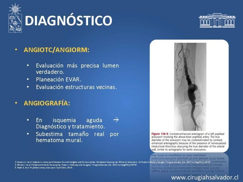 Diapositiva 13 de Aneurismas periféricos