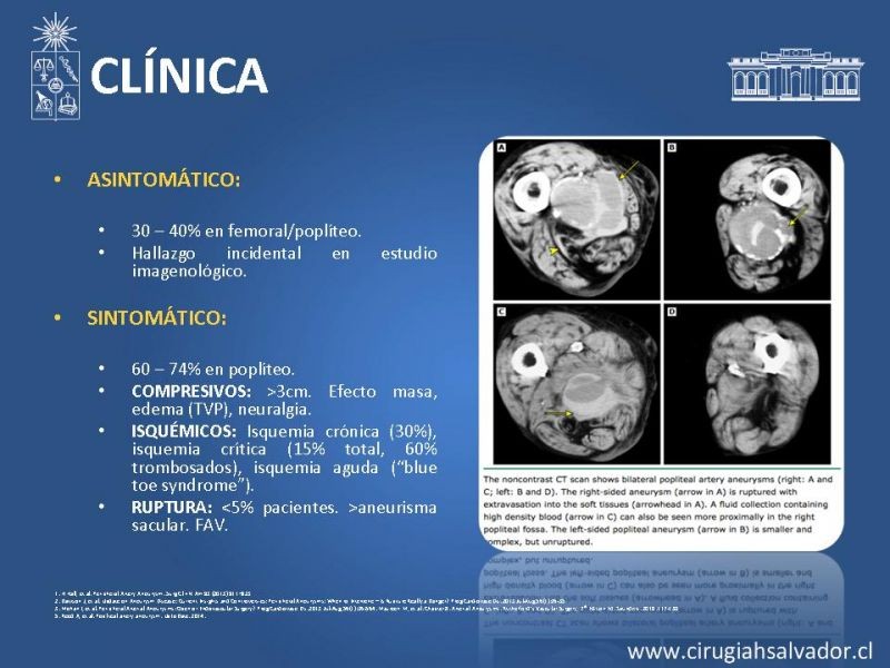 Diapositiva 9 de Aneurismas periféricos