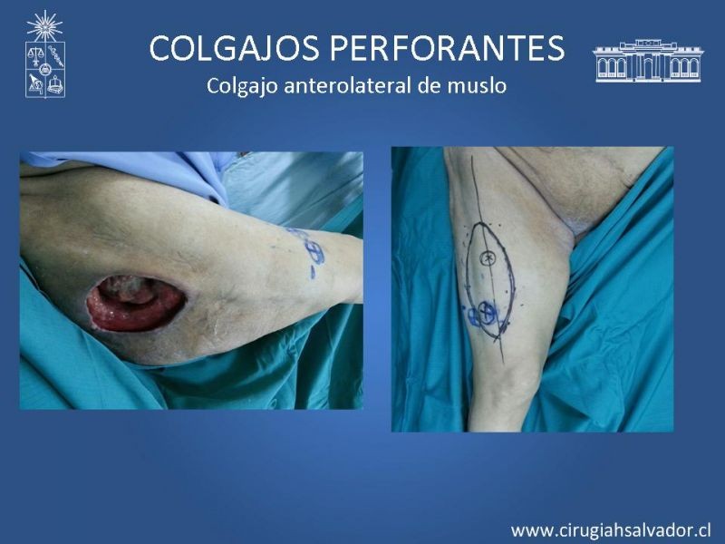 Diapositiva 26 de Colgajos perforantes: Anatomía-usos