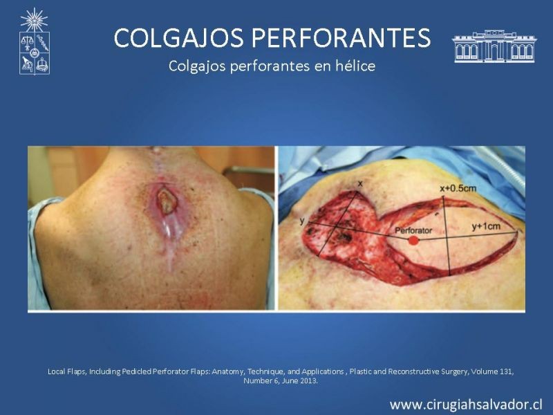 Diapositiva 42 de Colgajos perforantes: Anatomía-usos