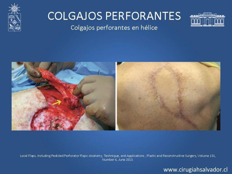 Diapositiva 43 de Colgajos perforantes: Anatomía-usos