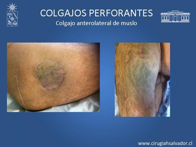 Diapositiva 28 de Colgajos perforantes: Anatomía-usos