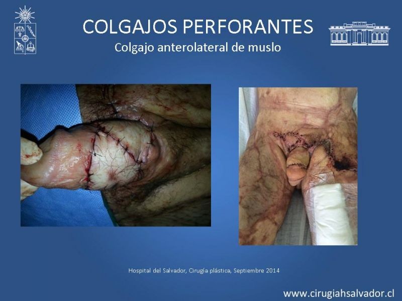 Diapositiva 25 de Colgajos perforantes: Anatomía-usos