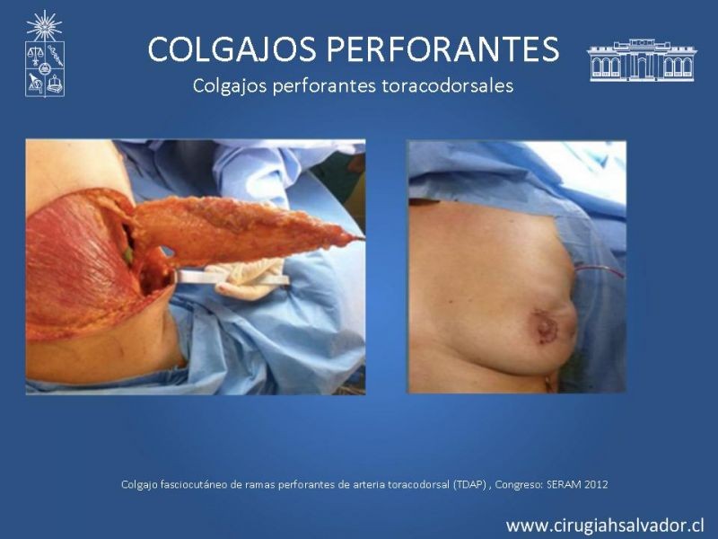 Diapositiva 39 de Colgajos perforantes: Anatomía-usos