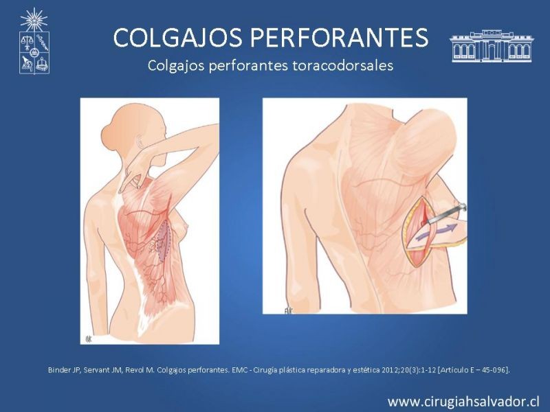 Diapositiva 37 de Colgajos perforantes: Anatomía-usos