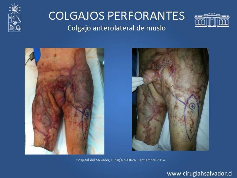 Diapositiva 23 de Colgajos perforantes: Anatomía-usos