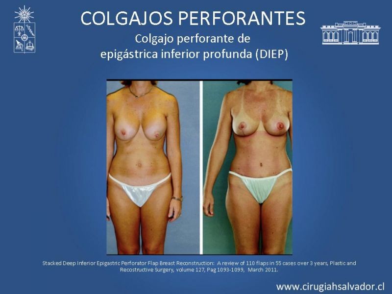 Diapositiva 19 de Colgajos perforantes: Anatomía-usos